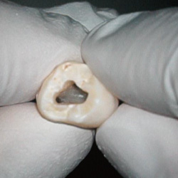 上顎大臼歯の内部の根管の入口